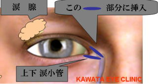 アテロコラーゲン挿入