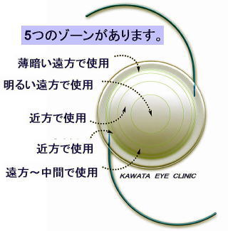 多焦点眼内レンズイメージ