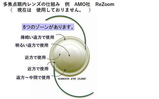 多焦点眼内レンズの仕組み