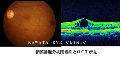 網膜静脈分枝閉塞症とOCT所見