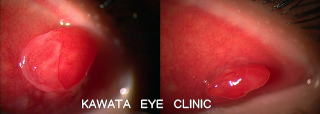 良性の眼瞼腫瘍05