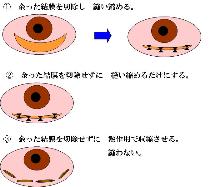 結膜弛緩症に対する手術の流れ