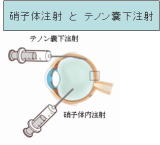 硝子体注射とテノン嚢下注射