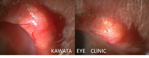 悪性の眼瞼腫瘍02